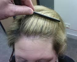 alopecia women