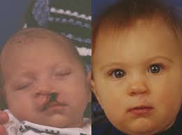 cleft lip palate