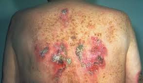 Gonorrhea in women/men