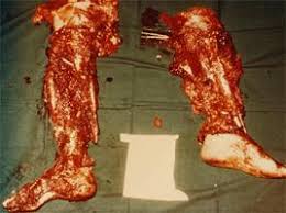 blown up bodies