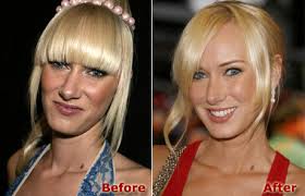 nose reconstruction