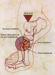 Lisfranc Injury of the Foot: A