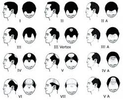 alopecia androgenetica