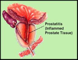 prostatitis stretches