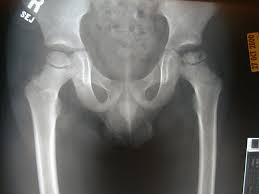 perthes disease