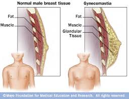 gynecomastia