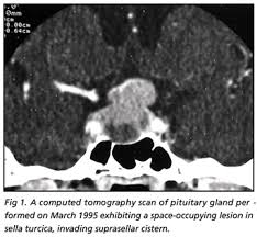 transsphenoidal approach