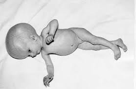 congenital hydrocephalus