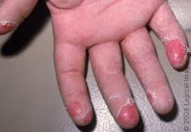 Picture of Scarlet Fever: