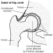perthes disease