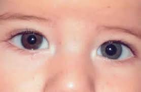 physiologic anisocoria
