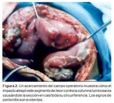 fractura de craneo