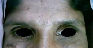 alopecia eyebrows