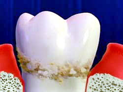 tartar removal