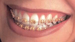 braces pictures