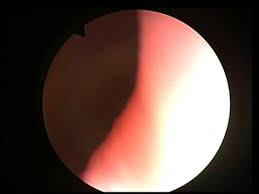 cystoscopy video