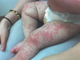 kawasaki disease The Cause of