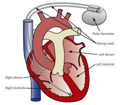heart pacemaker