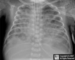 transient tachypnea of the newborn
