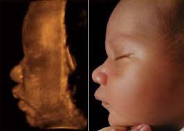 3d ultrasound pictures