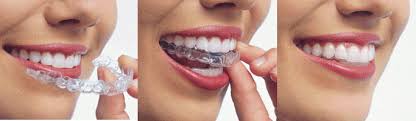 removable orthodontic appliances