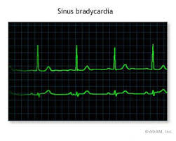 slow heartbeat