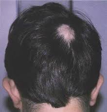 alopecia picture