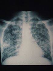 tuberculose miliaire