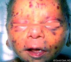 viral infections