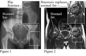 perthes disease