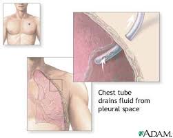 chest drain