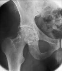 villonodular synovitis and symptoms