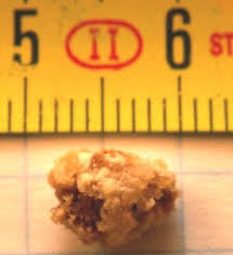 8mm Kidney Stone