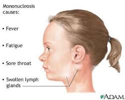Guillain-Barr� Syndrome is