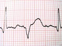 slow heartbeat
