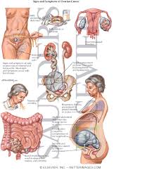 Signs and Symptoms of Ovarian