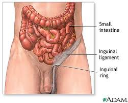 Inguinal hernia repair