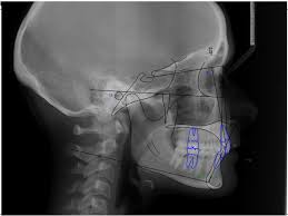 cephalometric radiograph