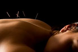 Acupuncture Lmbs_acupuncture