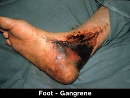   Gangrene_foot