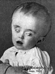 congenital hydrocephalus