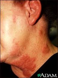 shingles virus