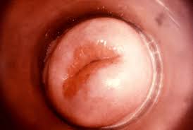 Gonorrhea