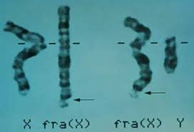 fragile x chromosome