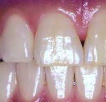 dental enamel