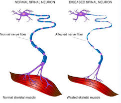 Patients who have ALS (Lou