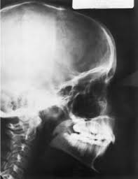 cephalometric radiograph