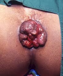 hemorroid treatment