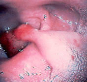 anorectal bleeding