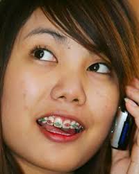 braces pictures